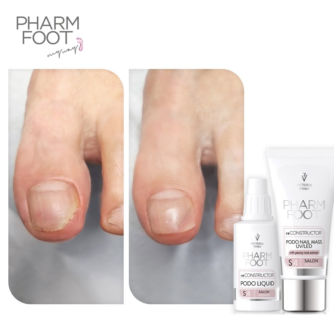 PHARM FOOT Nagu rekonstruktors , reConstructor Podo Nail Set UV/LED