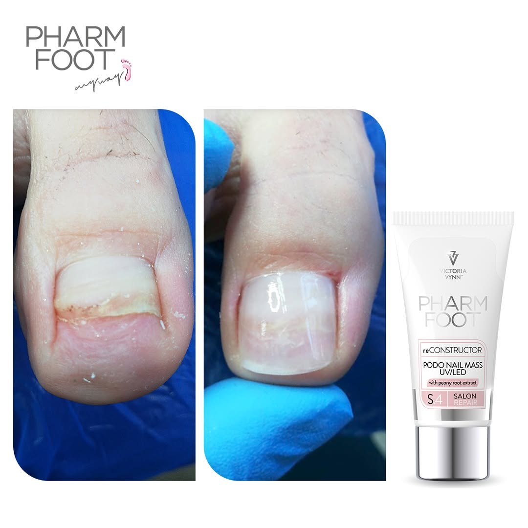 PHARM FOOT Nagu rekonstruktors , reConstructor Podo Nail Set UV/LED