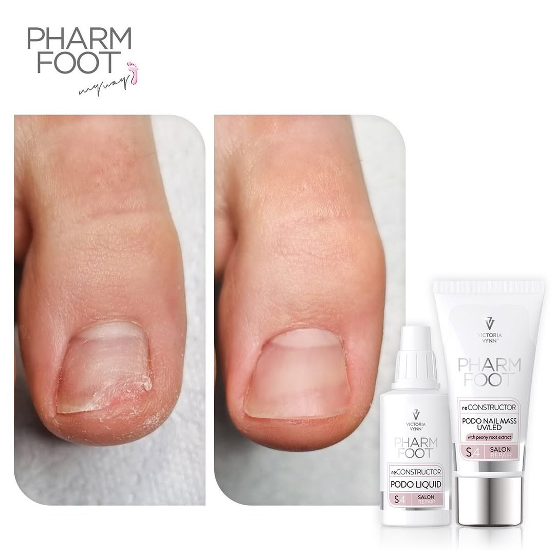 PHARM FOOT Nagu rekonstruktors , reConstructor Podo Nail Set UV/LED