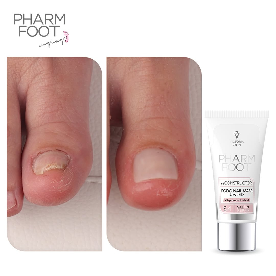 PHARM FOOT Nagu rekonstruktors , reConstructor Podo Nail Set UV/LED