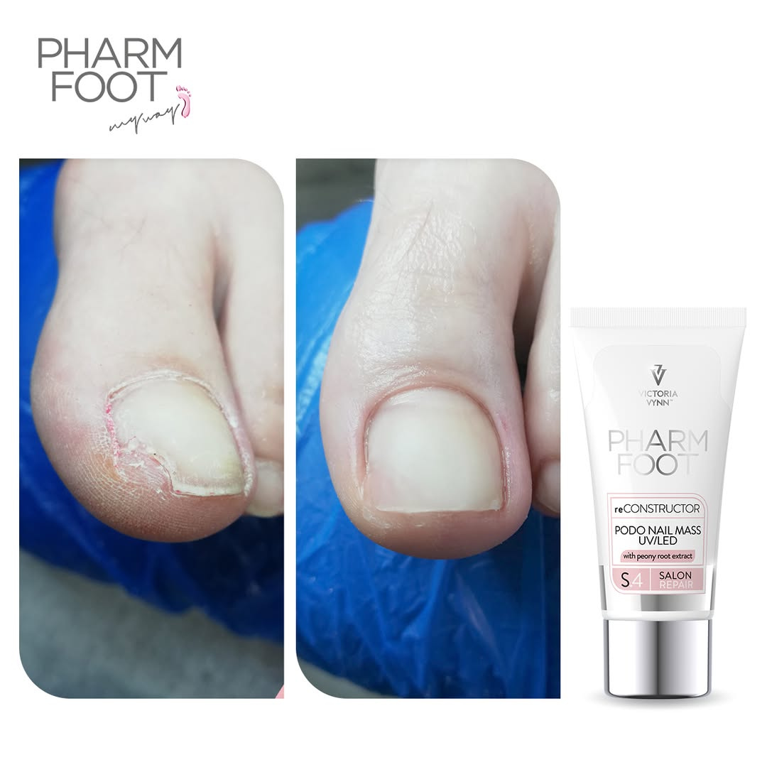 PHARM FOOT Nagu rekonstruktors , reConstructor Podo Nail Set UV/LED
